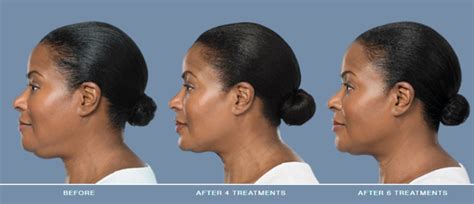 Kybella Double Chin Injections Dr Ali