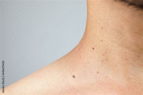 Close Up Of A Skin Problem With Polyps On The Neck Of A Man