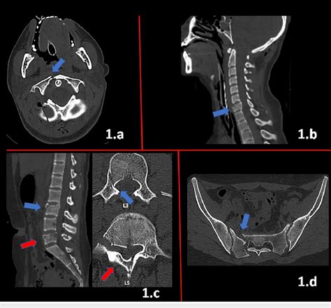 A Cervical Ct Axial View Right C1 Anterior Arch Fracture Blue