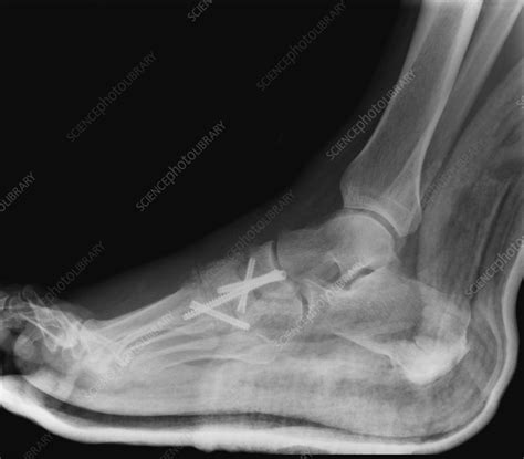 Osteoarthritis Of The Foot X Ray Stock Image C0119703 Science