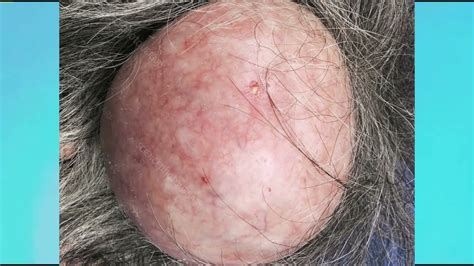 Pilar Cysts Popping Treating And Extracting Scalp Cysts With Thinergy