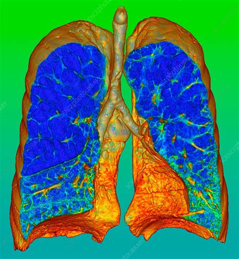 Smokers Lungs And Emphysema 3d Ct Scan Stock Image C0360516