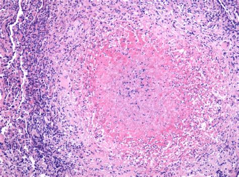 Overview Of A Tb Granuloma Evidentiated Through Transbronchial Biopsy