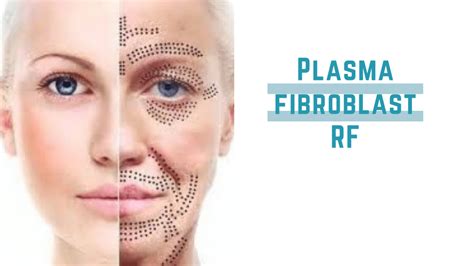 Plasma Fibroblasts Tightening Of The Skin My Perfect Skin Clinic