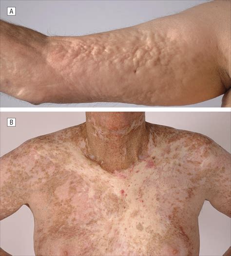 A Call For More Dermatologic Input Into Chronic Graft Vs Host Disease