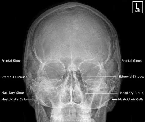 This patient had a chronic disease with progressive consolidation. Sinuses Radiographic Anatomy - wikiRadiography | Radiology ...