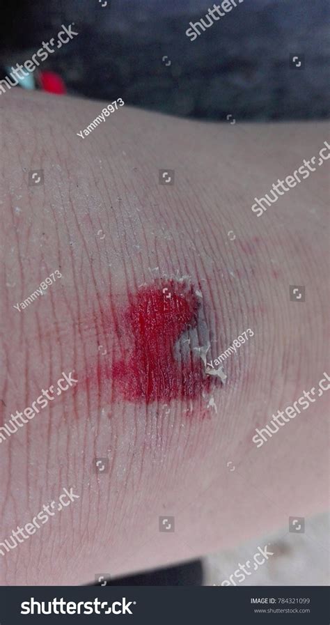 Laceration Wound Caused By Severe Shocks Stock Photo 784321099