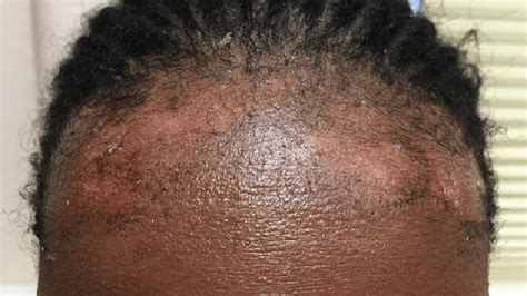 Top More Than 75 Eczema In Hair Super Hot Ineteachers