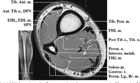 Figure 4 From Normal Mr Imaging Anatomy Of The Thigh And Leg