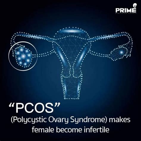 Pcos Polycystic Ovary Syndrome Makes Female Become Infertile Icsi