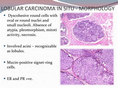 Pin Op Lobular Carcinoma