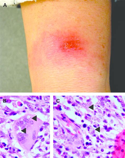 Cutaneous Old World Leishmaniasis Caused By Leishmania Tropica In An Download Scientific