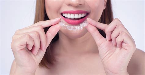 Aparelho ortodôntico Invisalign rapidez no alinhamento dental