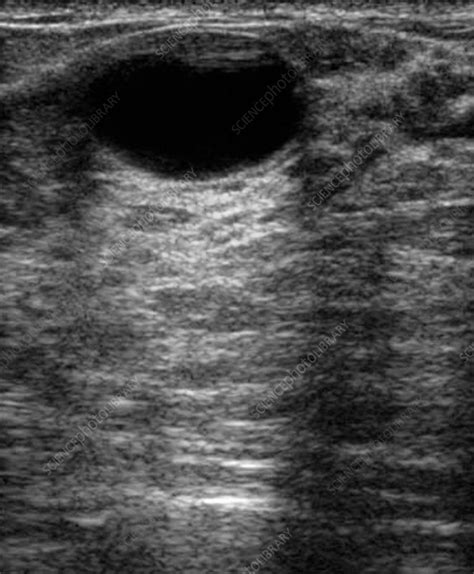 Fibrocystic Disease Ultrasound Scan Stock Image M1220437