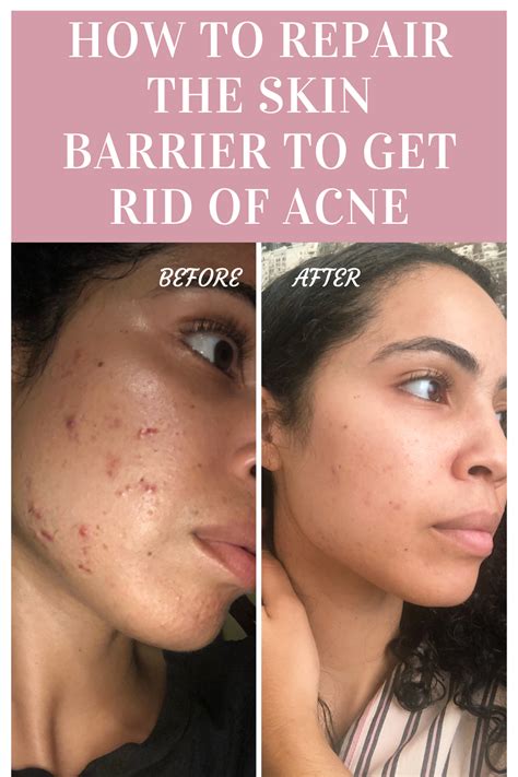 Repairing The Skin Barrier To Get Rid Of Acne Before And After Results