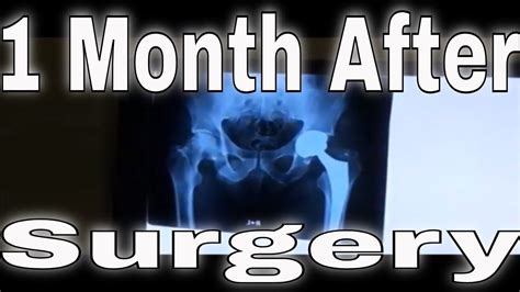 My Total Hip Replacement Surgery And Recovery 1 Month After Youtube