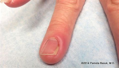 Paronychia is a soft tissue infection around a fingernail. Nail disorders - BASUK DERMATOLOGY