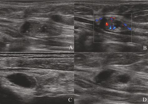Metastatic Lymph Nodes At Gray Scale Examination In Patients With