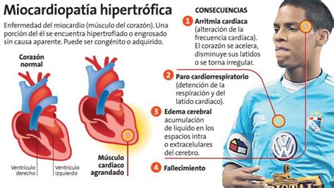 Cuales Son Los Sintomas De La Miocardiopatia Hipertrofica