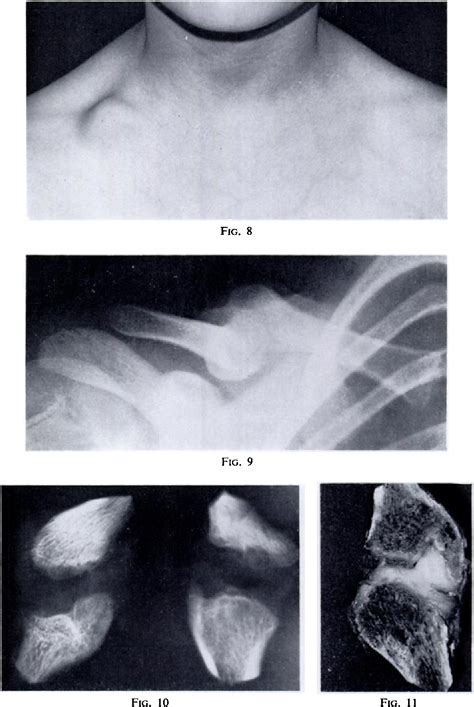 Figure 9 From Congenital Pseudarthrosis Of The Clavicle Semantic Scholar