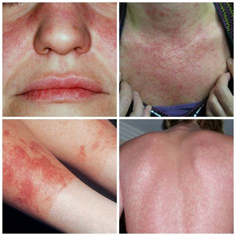 Malar Rash Defying Lupus