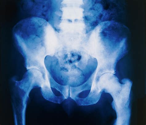 Prostate Cancer X Ray Of Secondary Bone Tumours Photograph By Science