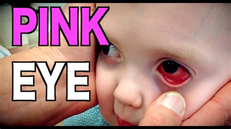 When looking at the latest photos of your kids, check out their eyes. PINK EYE: Live Diagnosis (Conjunctivitis) | Dr. Paul - YouTube