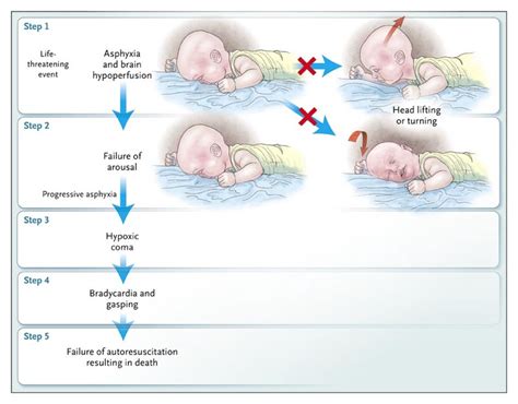 The Sudden Infant Death Syndrome Nejm