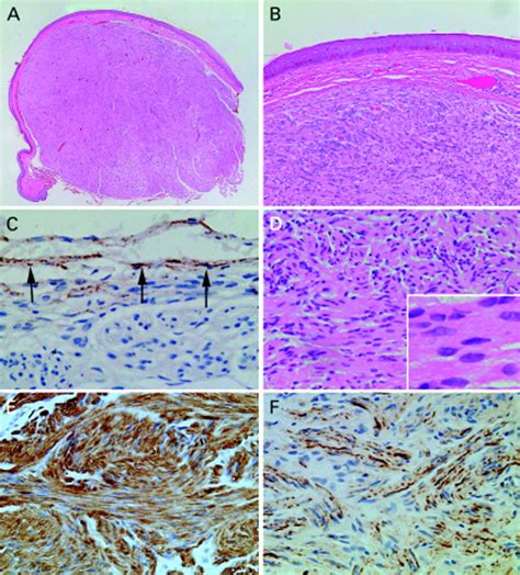 Palisaded Encapsulated Neuroma Solitary Circumscribed Neuroma Of Skin