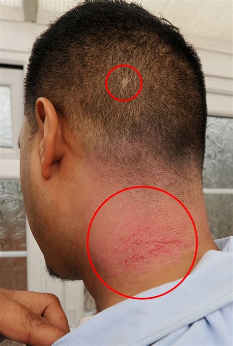 False Widow Spider Bite Turns Skin On Plumber Sunil Dades Neck Black