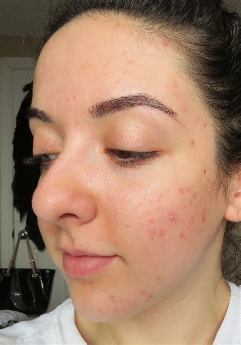 My Skins Journey Week 4 Banish Acne Scars