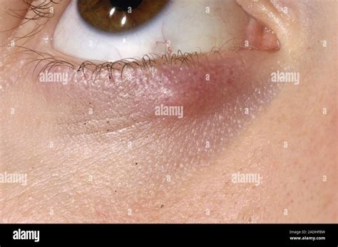 Model Released Cyst Chalazion Under The Lower Eyelid Of A 13 Year