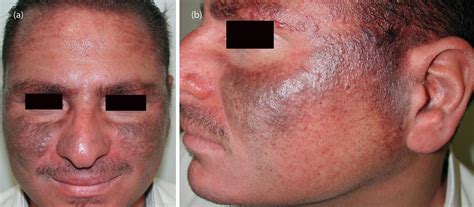 Isotretinoin Induced Facial Hyperpigmentation Idiosyncratic Reaction