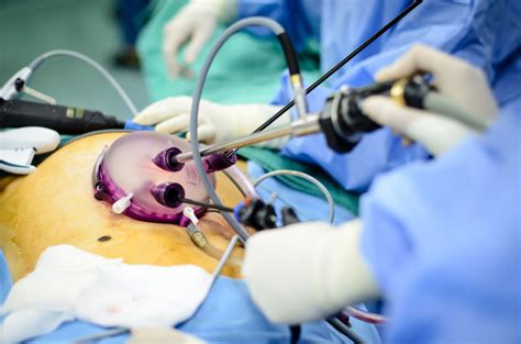 Very few contraindications for laparoscopic assisted bowel surgery have been identified in the literature. Fibroid Morcellation: A Cautionary Tale - Uterine Fibroid ...