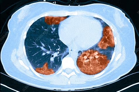 Lungs With Vaping Damage Baseline Ct Stock Image C0504442