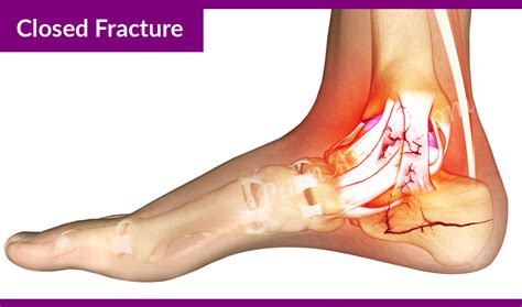 Pin By Great Wolf On Heel Fractures Calcaneus Fracture Treatment Hot