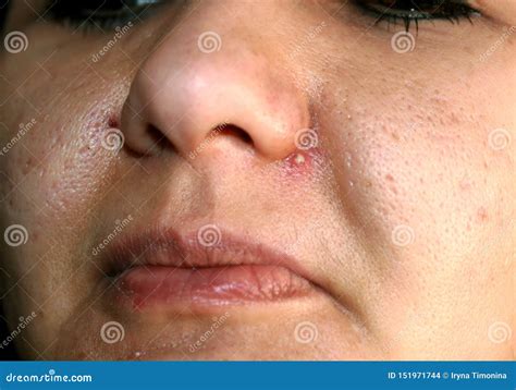 Inflamed Skin Of The Face Acne Pimple Purulent On The Nose Stock