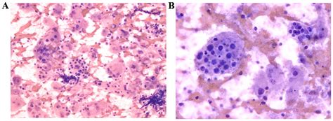 Cytological Diagnosis Of Rosai‑dorfman Disease A Case Report And