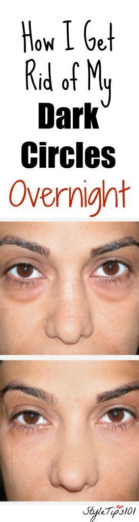 We did not find results for: How to Get Rid of Dark Circles Overnight | Under eye bags ...