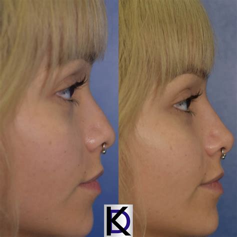 Beauty By Dr Kay Plastic Surgery Before And After Photos