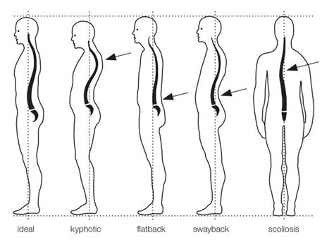 What Posture Type Are You