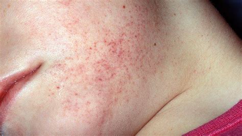 Sign Of Skin Cancer Rash