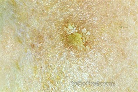Actinic Keratosis Picture Causes Treatment Images