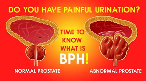 Episode 9 Do You Have Painful Urination It Can Be A Bph Benign