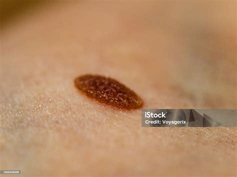 Closeup Brown Mole On Skin Stock Photo Download Image Now Close Up