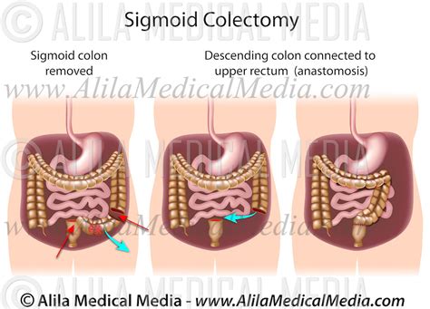 Sigmoid Colectomy Alila Medical Images