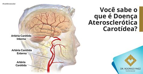 Doença Aterosclerótica Carotídea Saiba mais sobre esta doença Dr