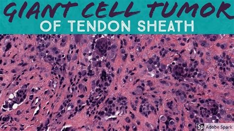 Giant Cell Tumor Of Tendon Sheath Minute Pathology Pearls Youtube