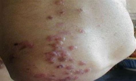 Itchy Elbows With Red Bumps Rash Welts Treatment