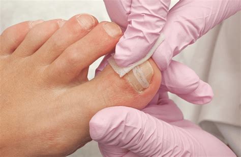 Ingrown Toenail Removal Phoenix Az Ingrown Nail Doctor Valley Foot Care